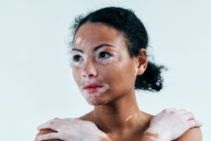 Pele com vitiligo exige cuidados especiais e hidratação reforçada!