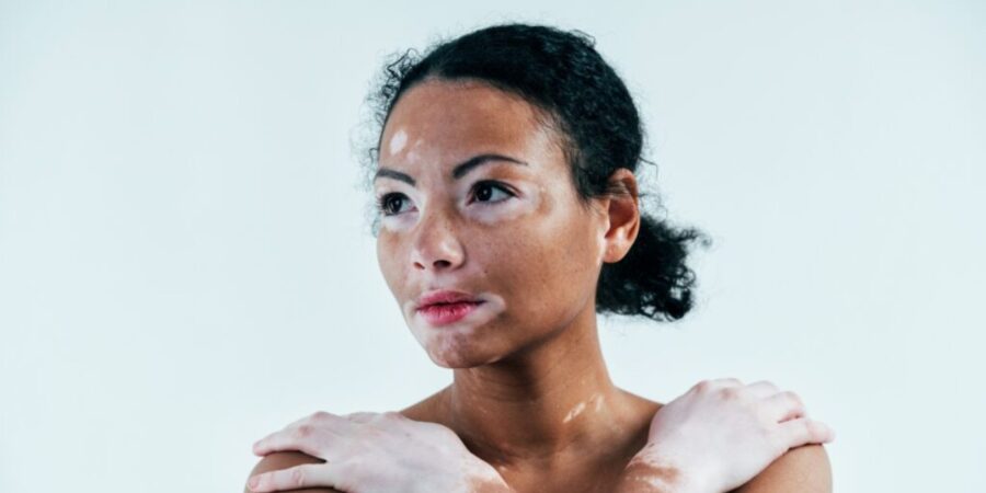 Pele com vitiligo exige cuidados especiais e hidratação reforçada!